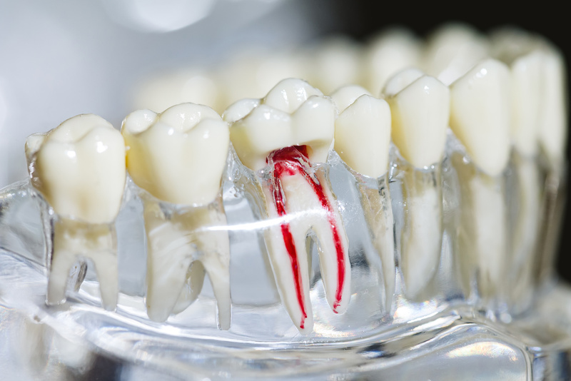 Dental implant, artificial tooth roots into jaw, root canal of d