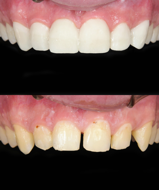Before & After Smile Design